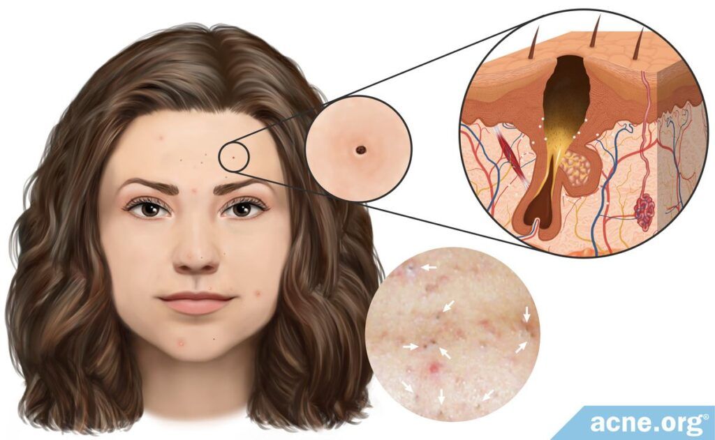 https://my.clevelandclinic.org/health/diseases/22038-blackheads#:~:text=What%20are%20blackheads%3F,Blackheads%20aren't%20pimples.