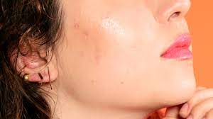cystic acne on cheeks