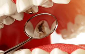 Treatments Of Tooth Decay