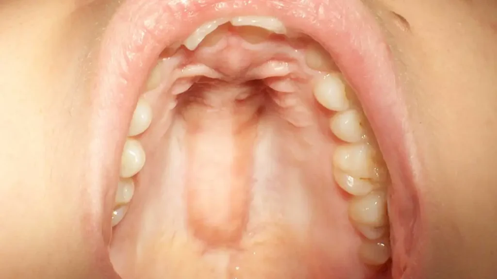 swollen roof of mouth
