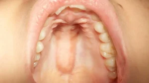 swollen roof of mouth